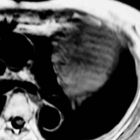 MRI T1W-Ax