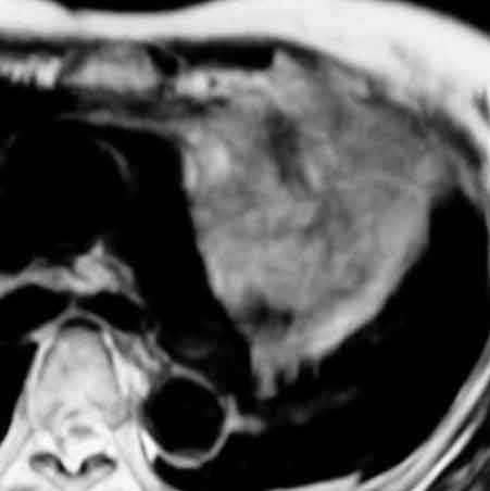 MRI T2W-Ax