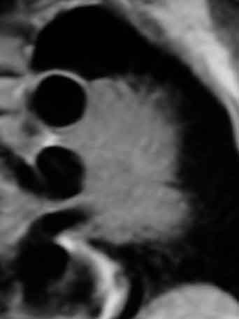 MRI T1W-Cr