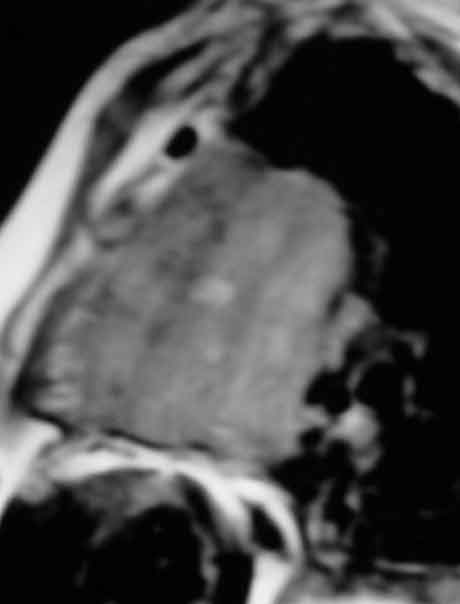 MRI T1W-Sg