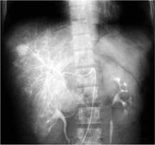 腹部Angiography画像