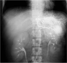 腹部Angiography画像