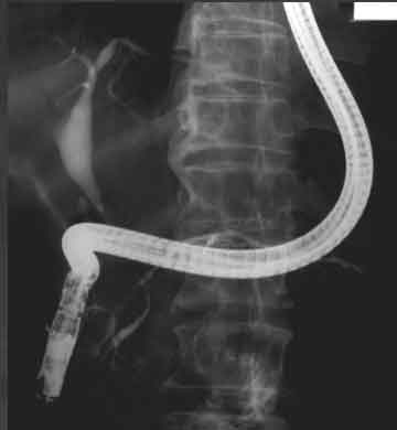 ERCP