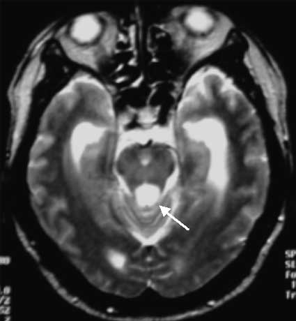 MRI T2-WIs