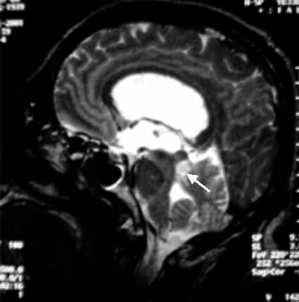 MRI T2-WIs