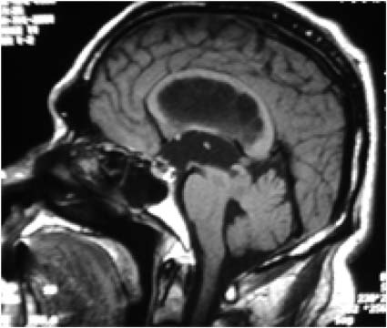 MRI T1-WIs