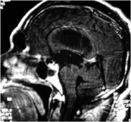 MRI T1-WIs