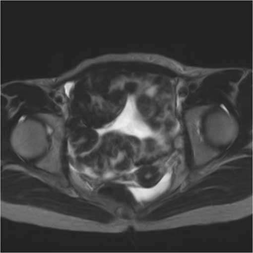 MRI (axial)/T2WI