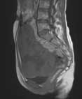 MRI (sagittal)/T1WI