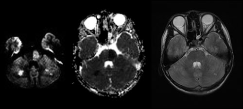 MRI