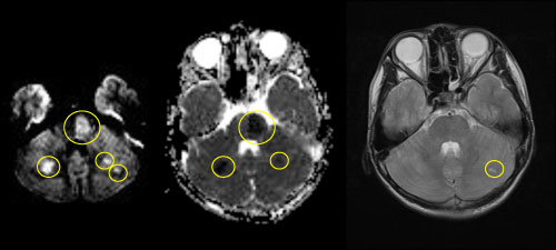 MRI