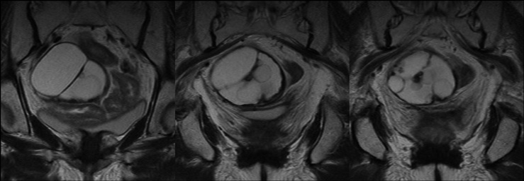 T2WI coronal