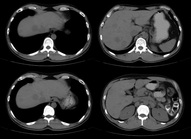 MRI