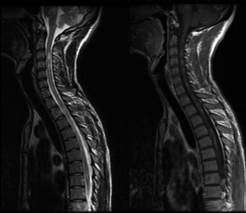 MRI